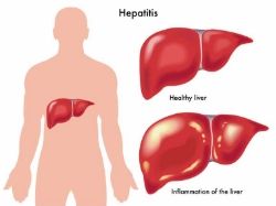 Penyebab dan gejala hepatitis