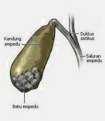 Tahitian Noni untuk Batu Empedu