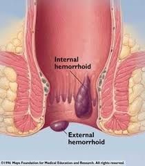 Hemoroid Internal dan Hemoroid External